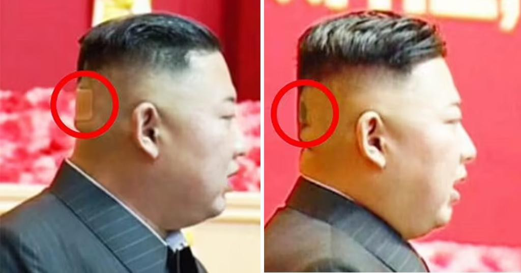 tamna mrlja, ponekad prekrivena velikim flasterom, na stražnjoj strani glave Kim Jong Una potaknula je spekulacija o njegovu narušenom zdravlju