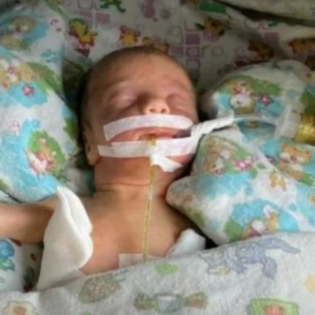 Mala Alba rođena 10 tjedana prije termina u ukrajinskoj Odesi