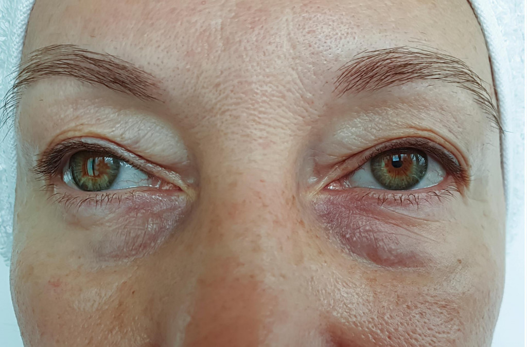 &lt;p&gt;woman eyes wrinkles after treatment&lt;/p&gt;