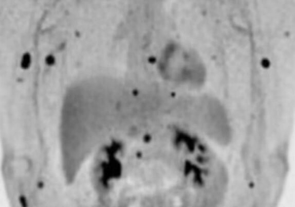 &lt;p&gt;CT snimka je pokazala da se tumor proširio po cijelom tijelu&lt;/p&gt;