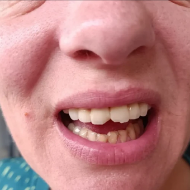 &lt;p&gt;Marija Laptalo pokazuje razbijene prednje zube nakon gastroskopije u KBC-u Split&lt;/p&gt;