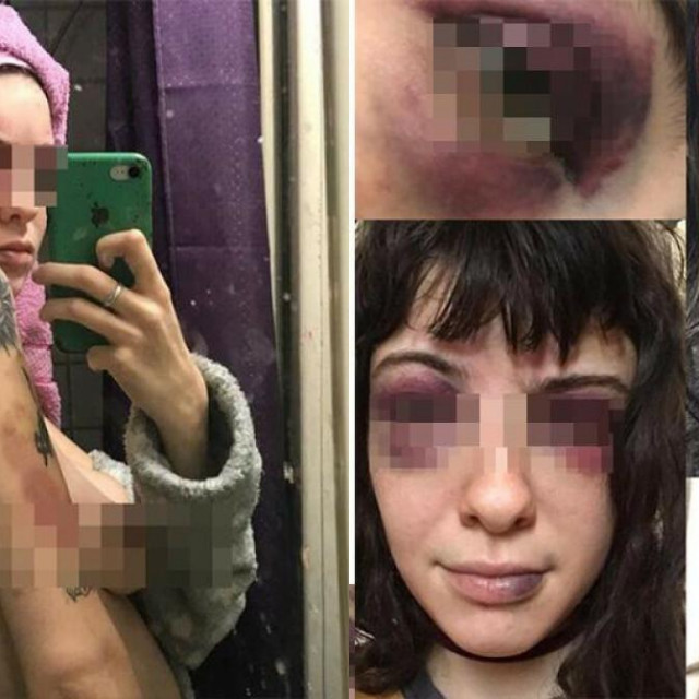 &lt;p&gt;Napadnuta djevojka objavila je fotografije svojih ozljeda - hematome ispod očiju, na rukama i leđima te posjekotine na usnici&lt;/p&gt;

&lt;p&gt; &lt;/p&gt;