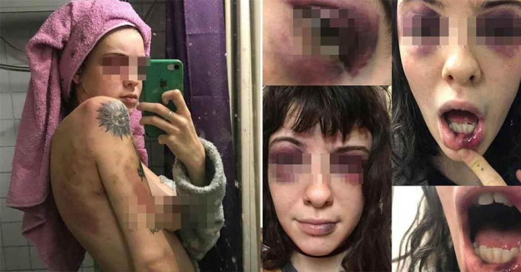 &lt;p&gt;Napadnuta djevojka objavila je fotografije svojih ozljeda - hematome ispod očiju, na rukama i leđima te posjekotine na usnici&lt;/p&gt;

&lt;p&gt; &lt;/p&gt;