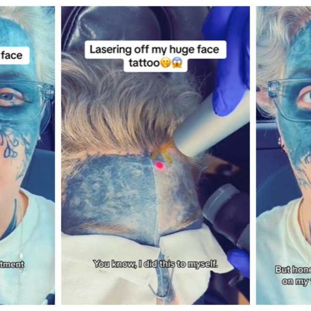 &lt;p&gt;Lynn o procesu skidanja tetovaže s lica&lt;/p&gt;
