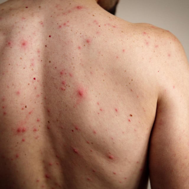 &lt;p&gt;A rash of red dots and blisters on a man‘s back. Chickenpox is much more severe in adults.&lt;/p&gt;