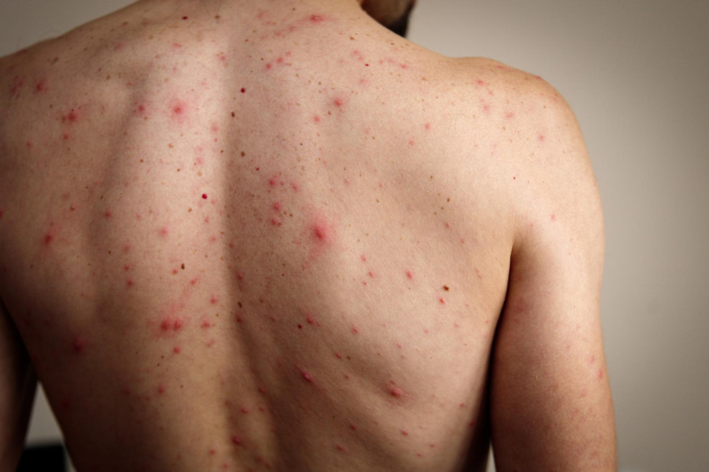 &lt;p&gt;A rash of red dots and blisters on a man‘s back. Chickenpox is much more severe in adults.&lt;/p&gt;