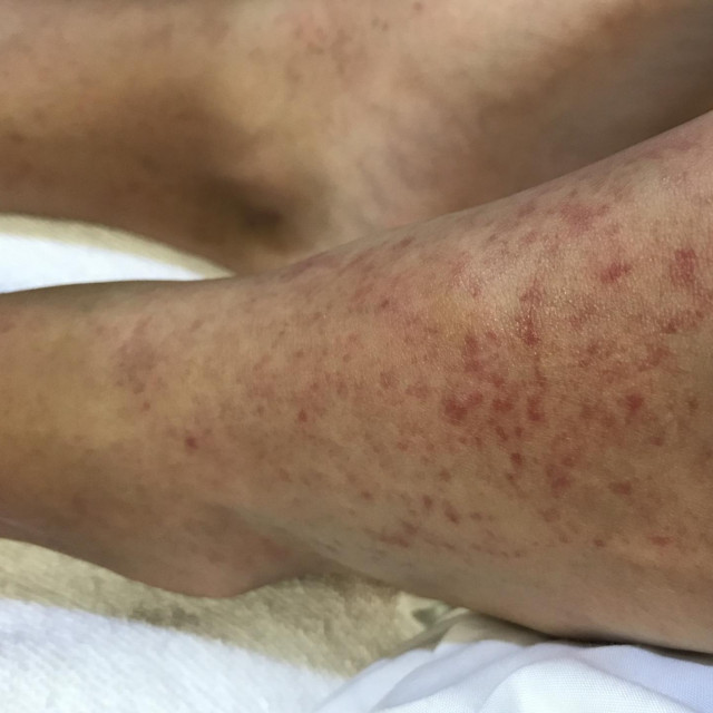 &lt;p&gt;Multiple well define erythematous pethichaie hemorrhage at feet in case Scarlet fever in a girl.&lt;/p&gt;