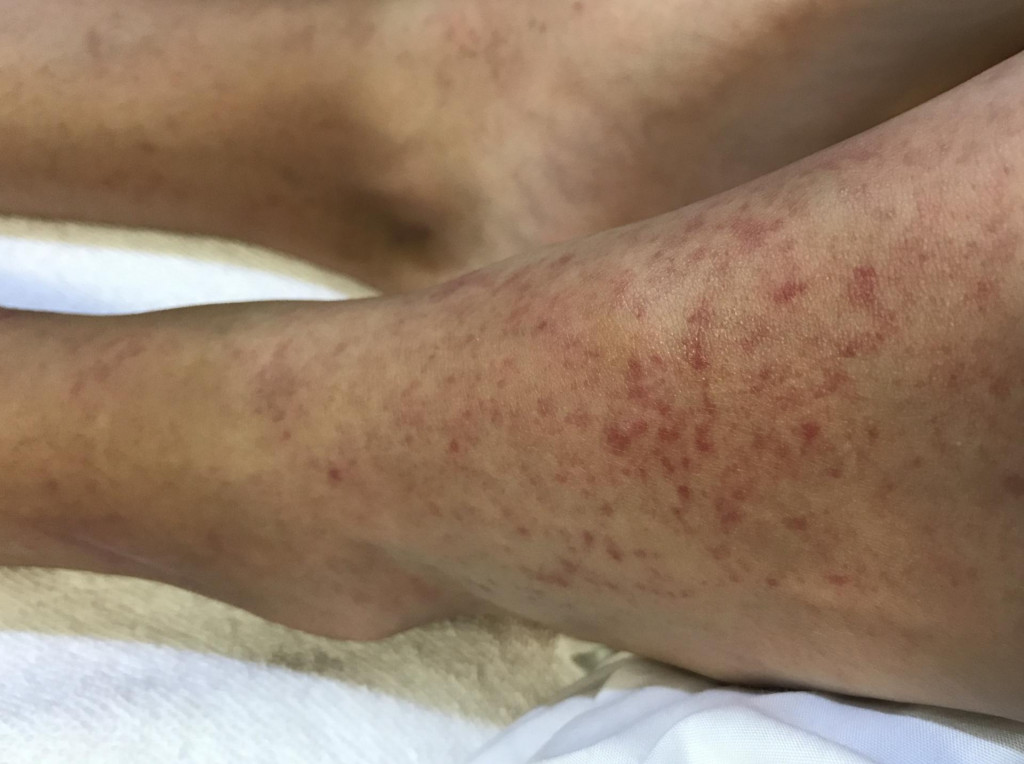 &lt;p&gt;Multiple well define erythematous pethichaie hemorrhage at feet in case Scarlet fever in a girl.&lt;/p&gt;