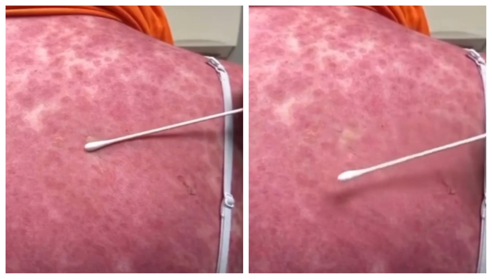 Nakon antibiotika dobila temperaturu i osip po cijelom tijelu: liječnici upozoravaju na opasnu reakciju