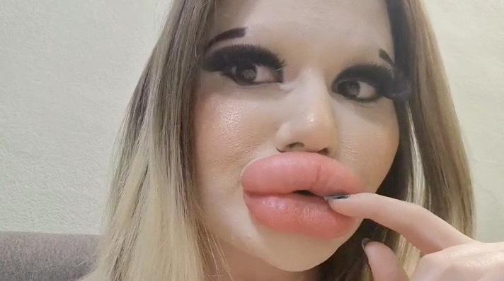 Potrošila je više od 26.000 dolara na filere za usne, a onda je objavila stare fotografije koje su šokirale javnost