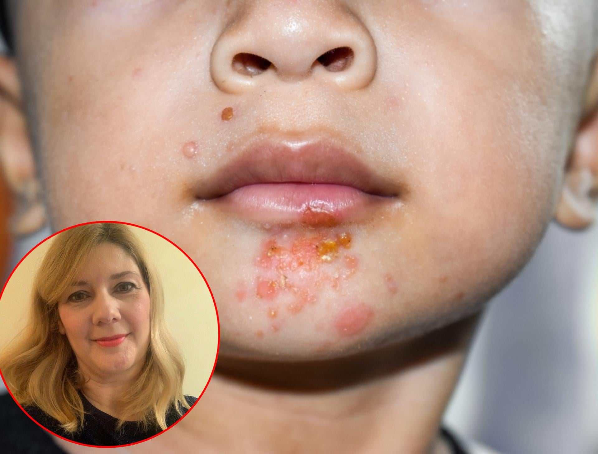 Što kad dijete dobije slatke kraste, imamo li epidemiju i je li more izvor zaraze? Sve smo ispitali splitsku pedijatricu