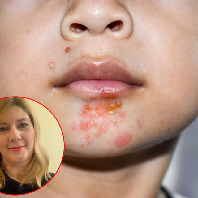 <p>Pedijatrica Jasna Petrić Duvnjak: &rdquo;Impetigo je vrlo zarazna bolest&rdquo;</p>