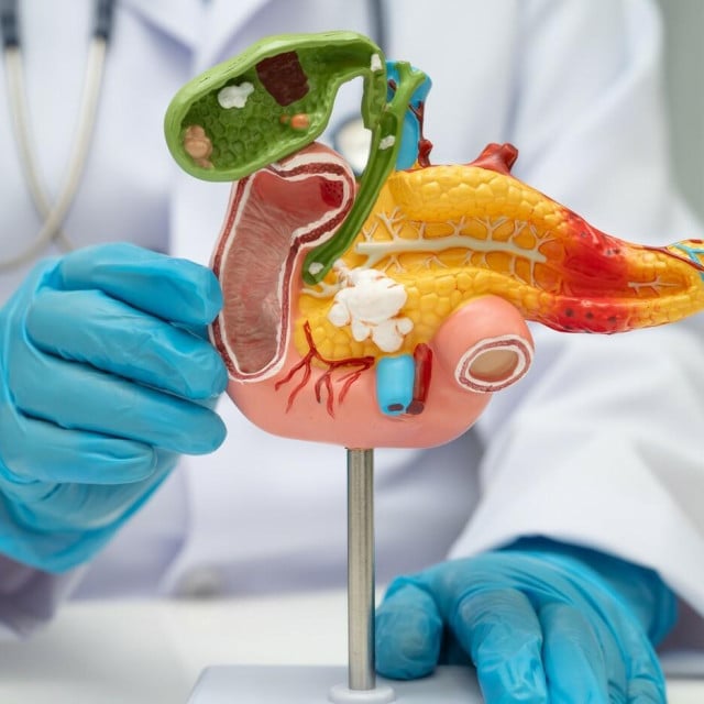 <p>Pancreatitis, pancreatic cancer, Asian doctor with pancreas, gallbladder and bile duct human anatomy model at hospital.,Image: 929243689, License: Royalty-free, Restrictions:, Model Release: no, Credit line: manassanant pamai/Panthermedia/Profimedia</p>