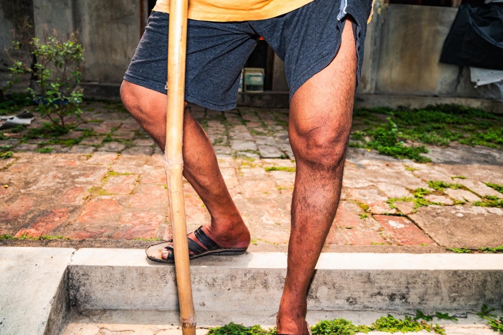 <p>Koljeno pacijenta zahvaćeno osteoartritisom</p>